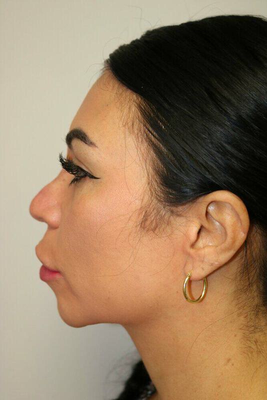 Non-Surgical Nose Job Before & After Image