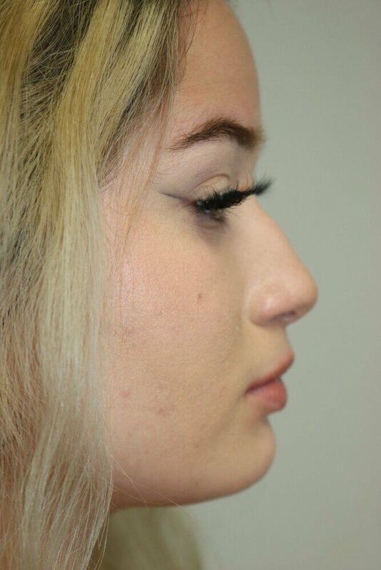 Non-Surgical Nose Job Before & After Image