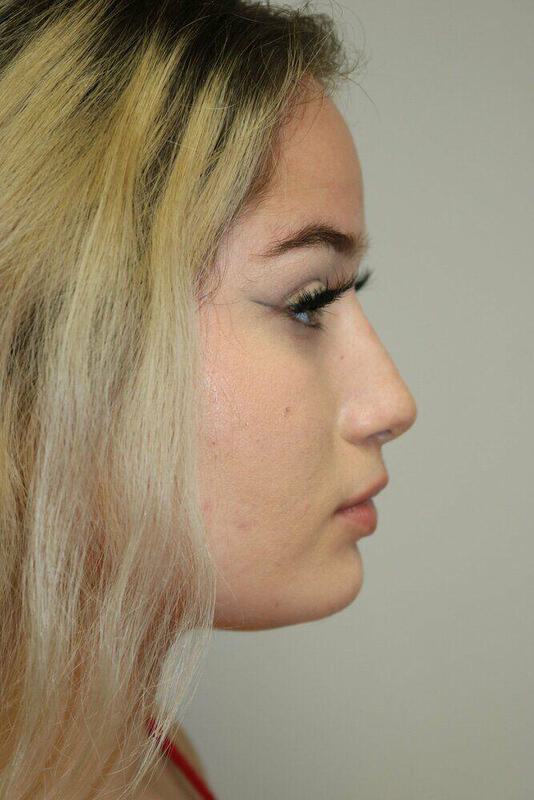 Non-Surgical Nose Job Before & After Image