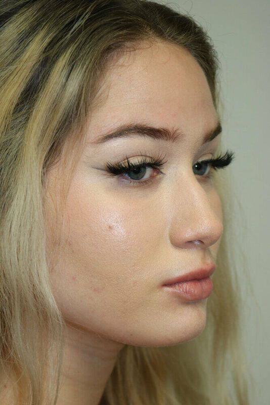 Non-Surgical Nose Job Before & After Image