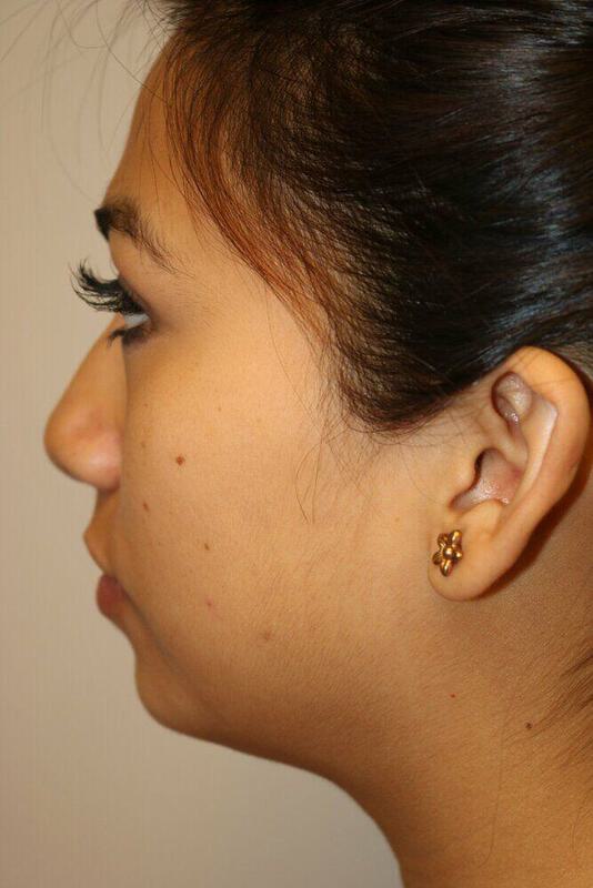 Non-Surgical Nose Job Before & After Image