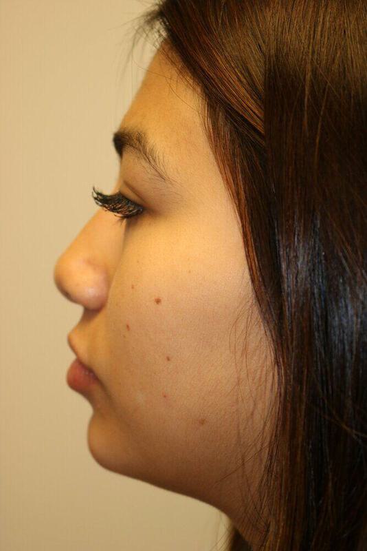 Non-Surgical Nose Job Before & After Image