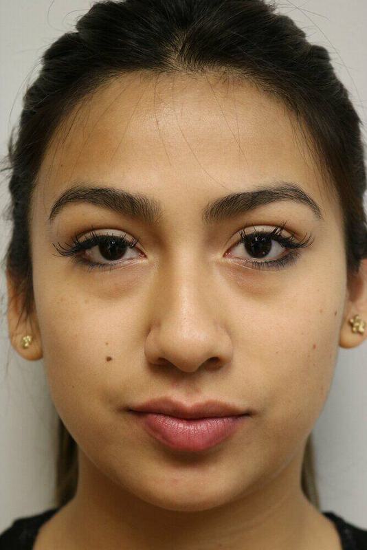 Non-Surgical Nose Job Before & After Image