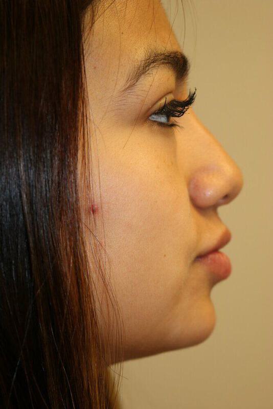 Non-Surgical Nose Job Before & After Image