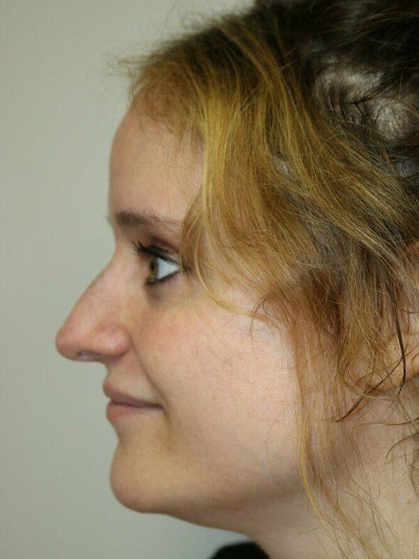 Non-Surgical Nose Job Before & After Image