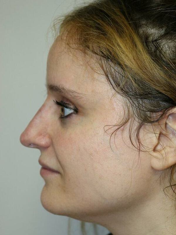 Non-Surgical Nose Job Before & After Image