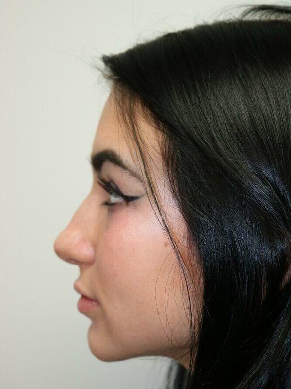 Non-Surgical Nose Job Before & After Image