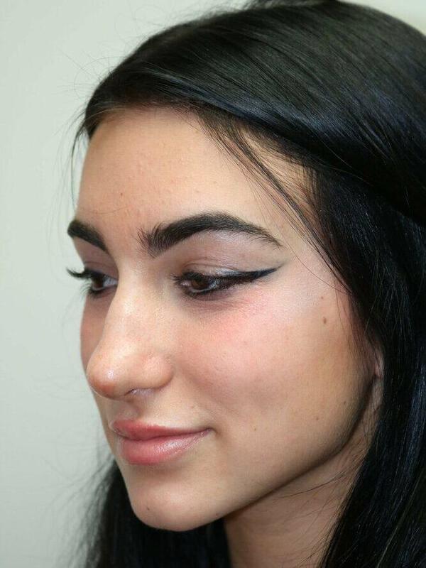 Non-Surgical Nose Job Before & After Image