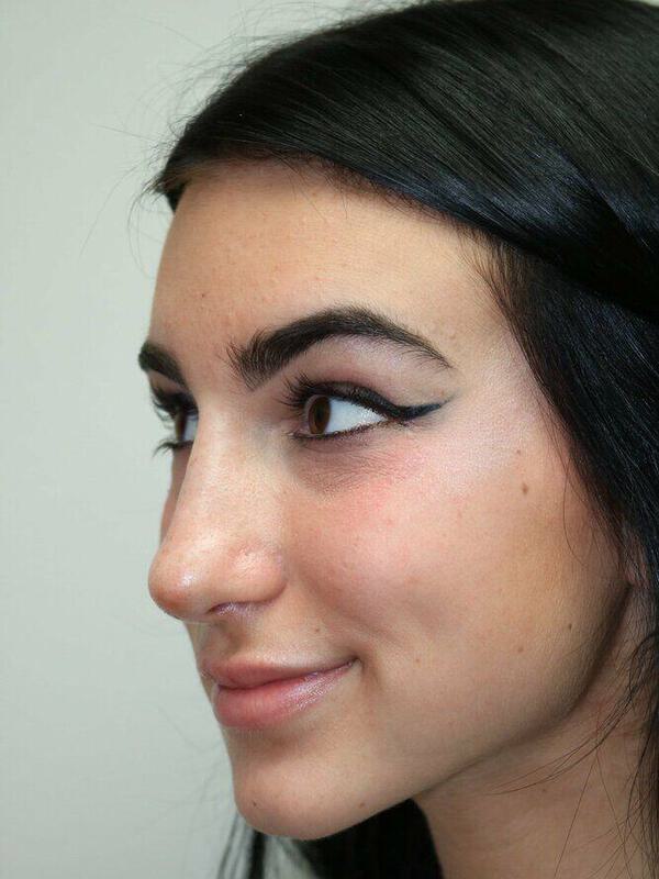 Non-Surgical Nose Job Before & After Image