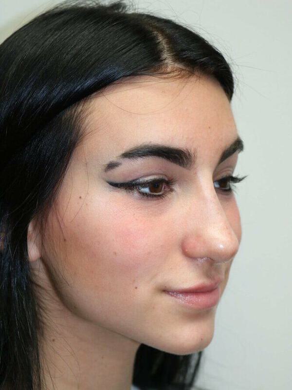 Non-Surgical Nose Job Before & After Image