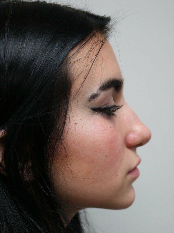 Non-Surgical Nose Job Before & After Image