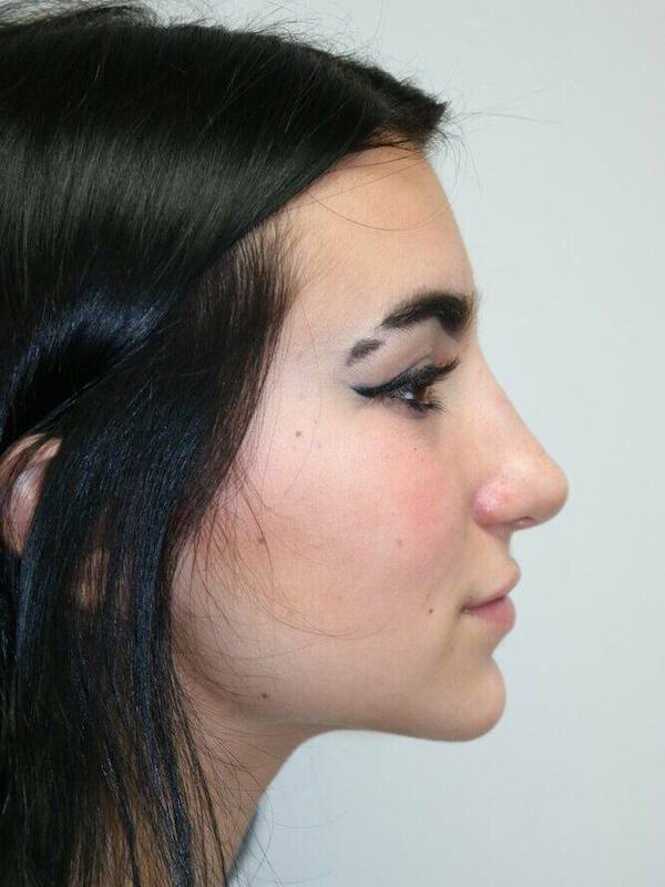 Non-Surgical Nose Job Before & After Image