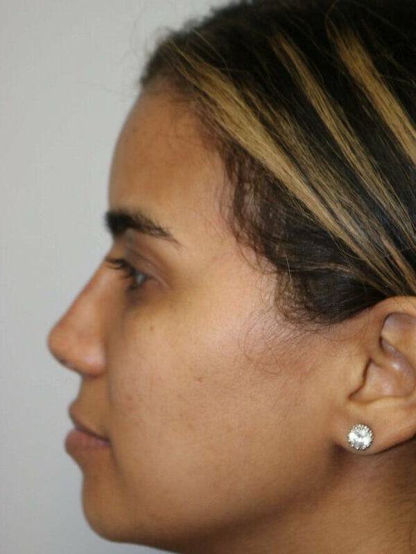 Non-Surgical Nose Job Before & After Image