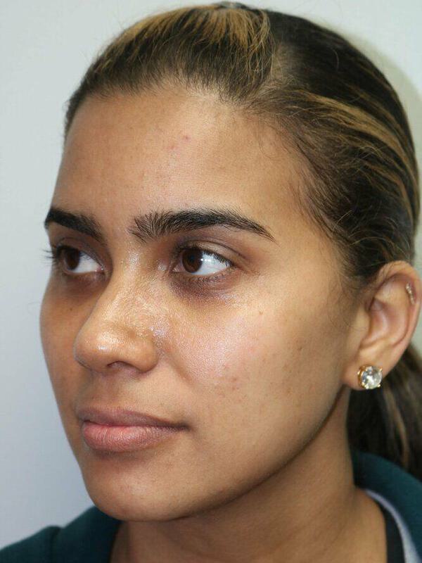 Non-Surgical Nose Job Before & After Image