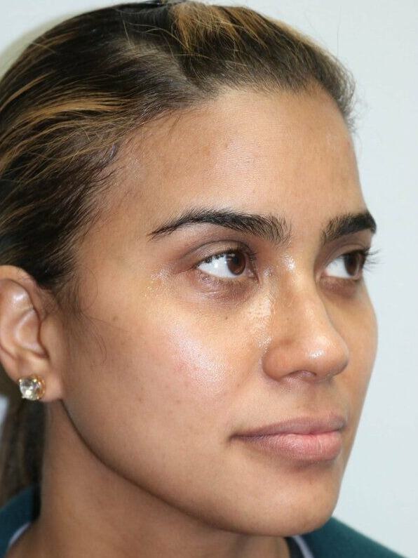 Non-Surgical Nose Job Before & After Image