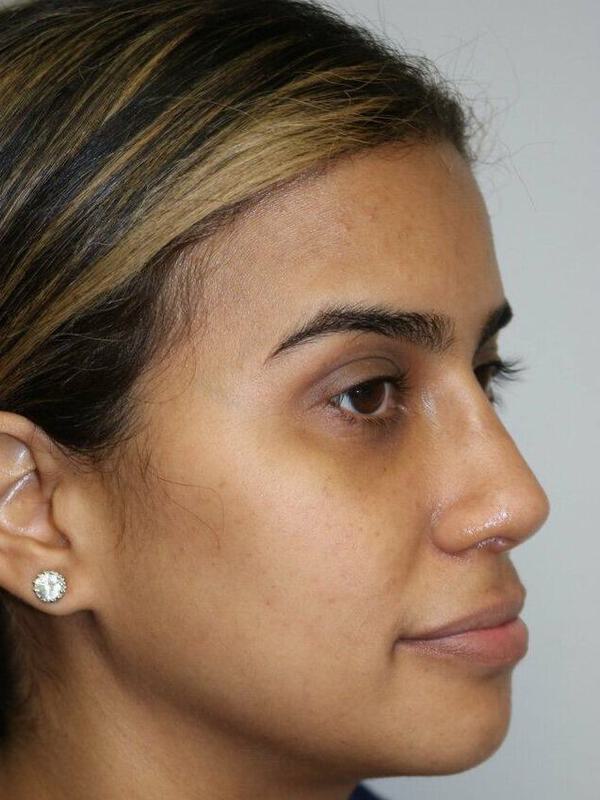 Non-Surgical Nose Job Before & After Image