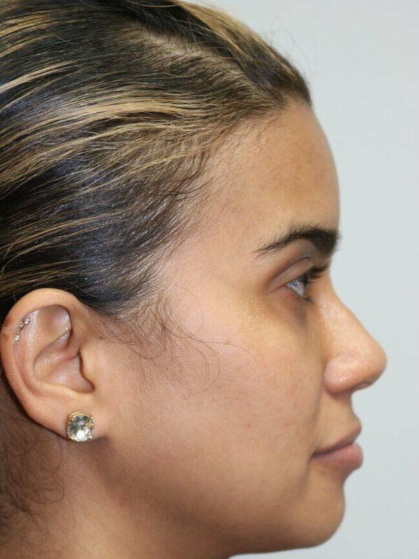 Non-Surgical Nose Job Before & After Image