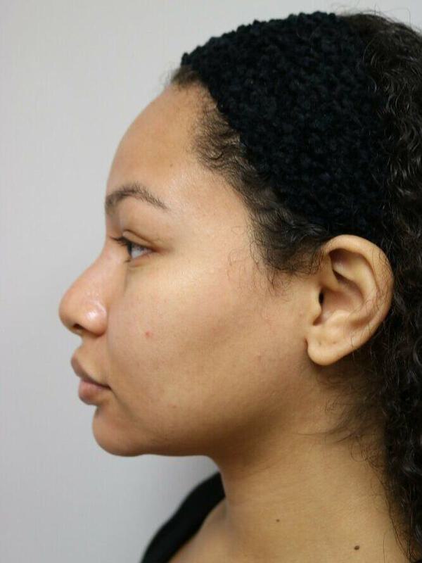 Non-Surgical Nose Job Before & After Image