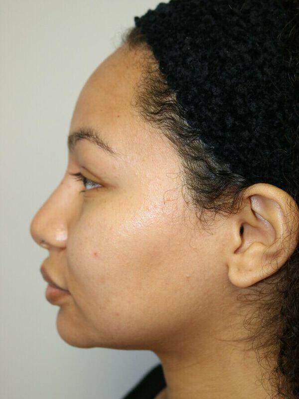 Non-Surgical Rhinoplasty Before & After Image
