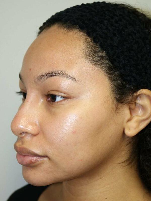 Non-Surgical Nose Job Before & After Image