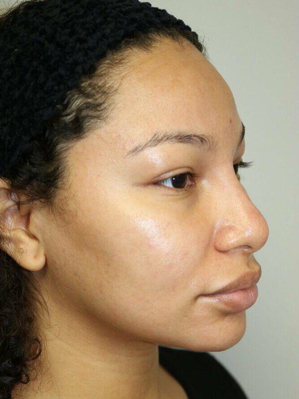 Non-Surgical Nose Job Before & After Image