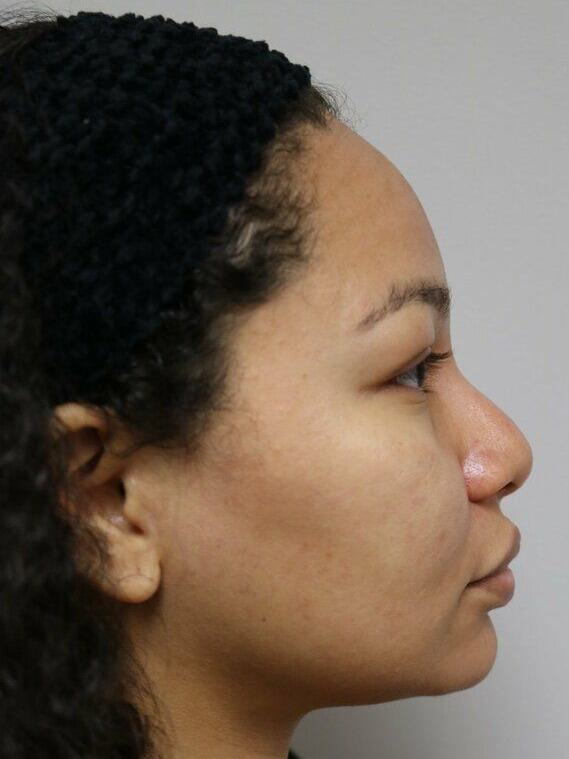 Non-Surgical Nose Job Before & After Image