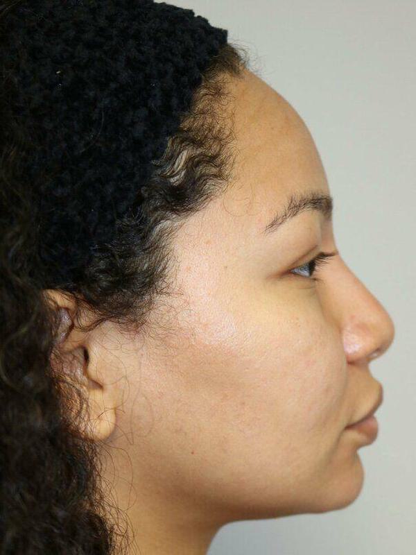 Non-Surgical Nose Job Before & After Image