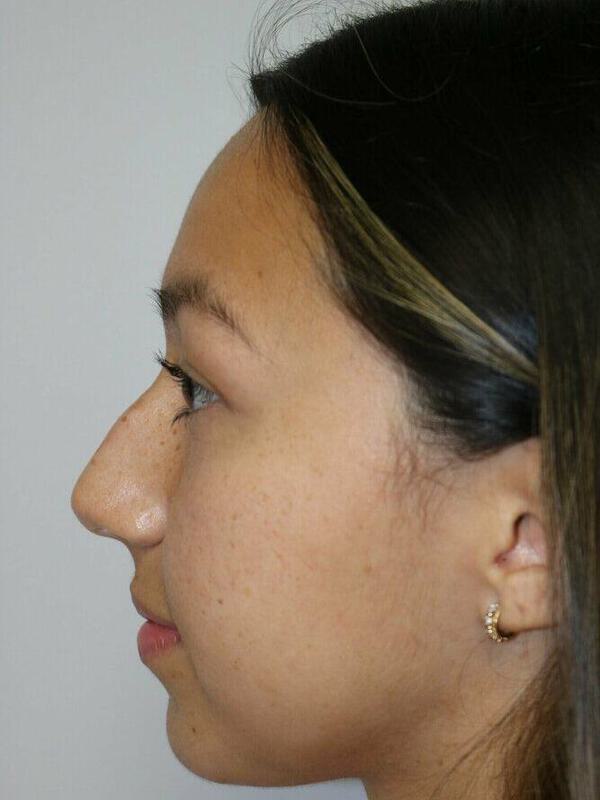 Non-Surgical Nose Job Before & After Image