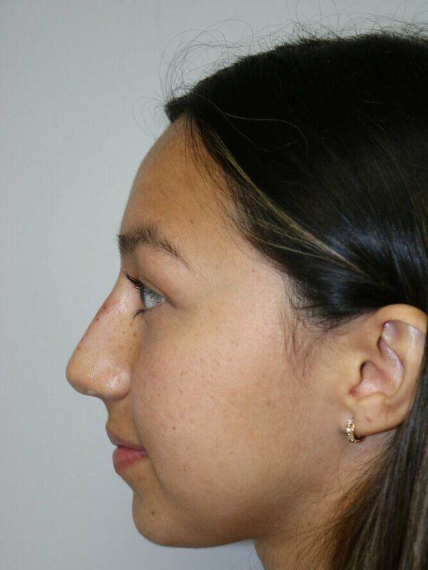 Non-Surgical Nose Job Before & After Image