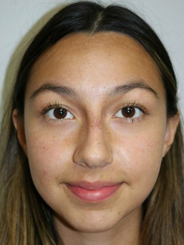 Non-Surgical Nose Job Before & After Image