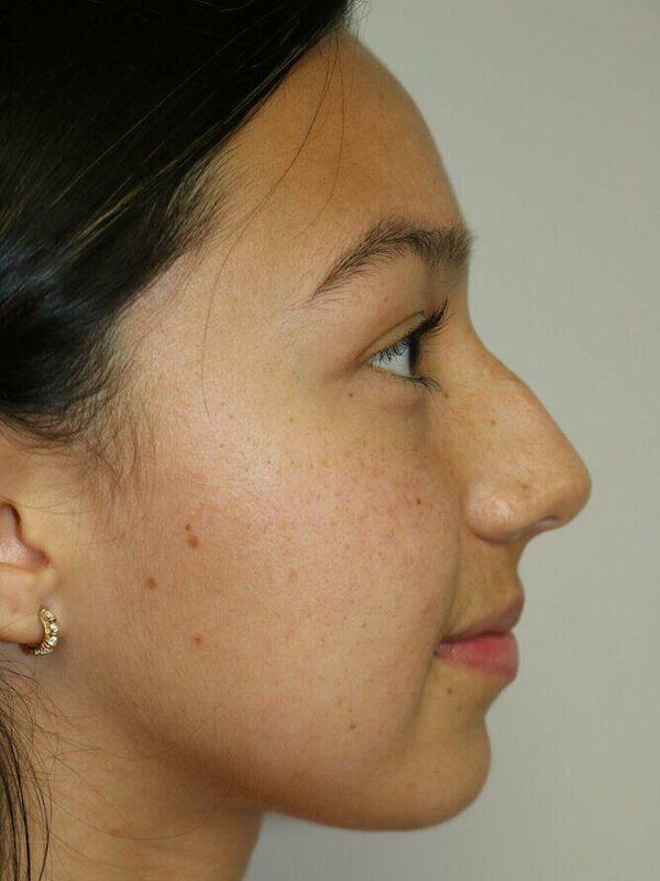 Non-Surgical Nose Job Before & After Image