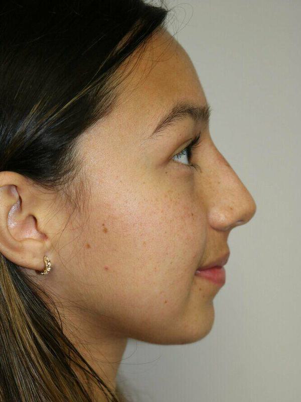 Non-Surgical Nose Job Before & After Image