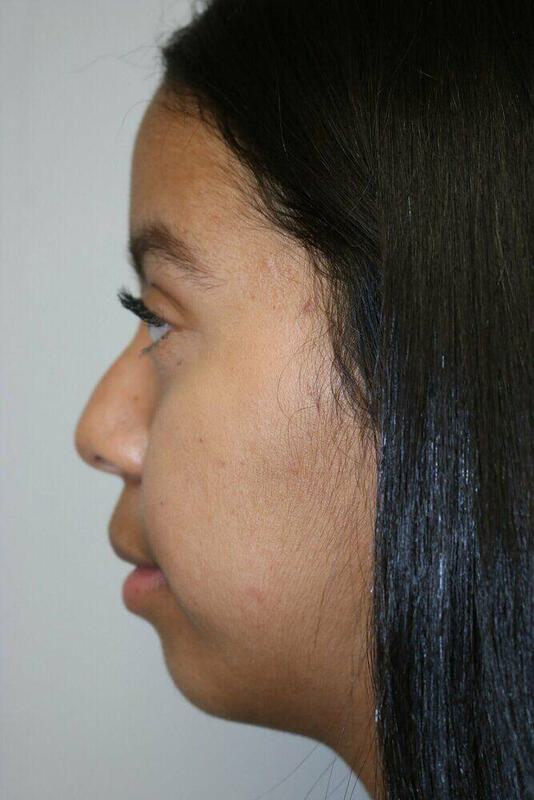 Non-Surgical Nose Job Before & After Image