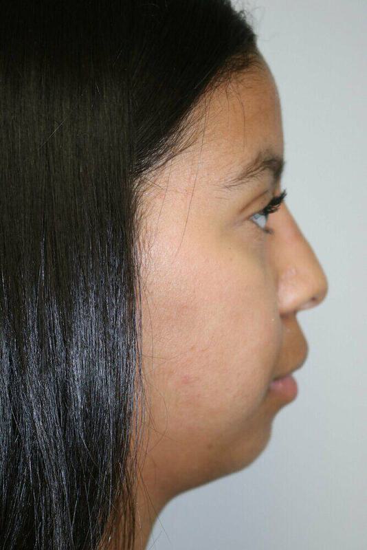 Non-Surgical Nose Job Before & After Image