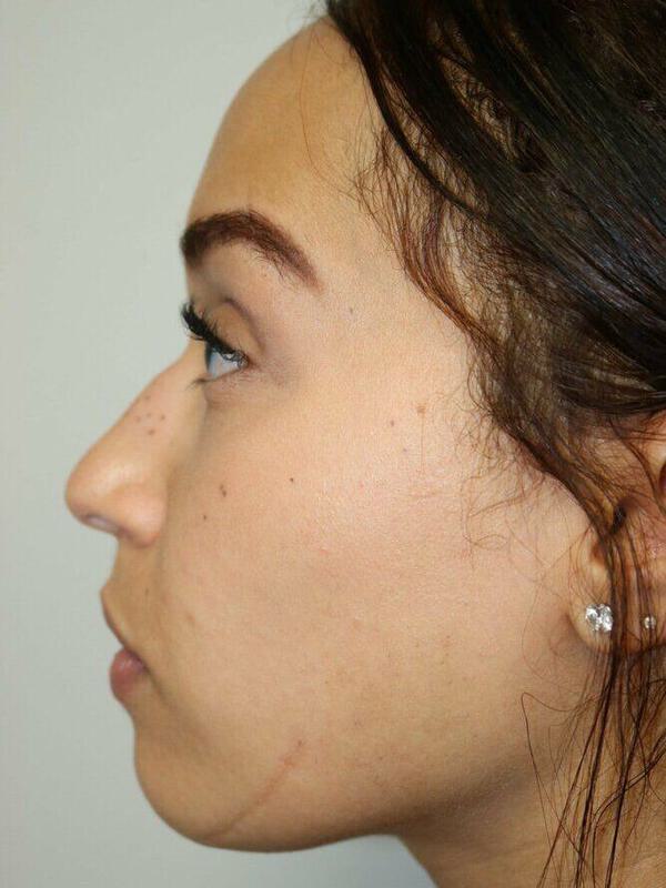 Non-Surgical Nose Job Before & After Image