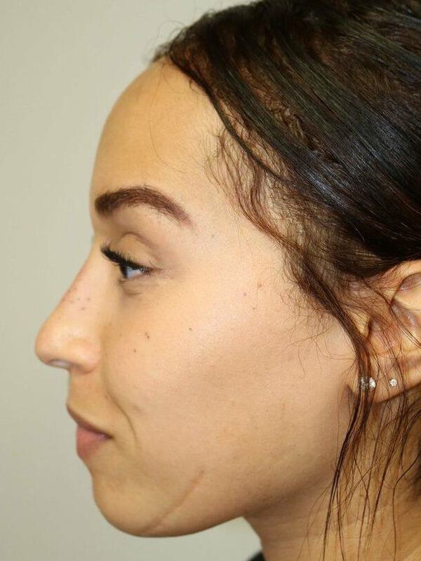 Non-Surgical Nose Job Before & After Image