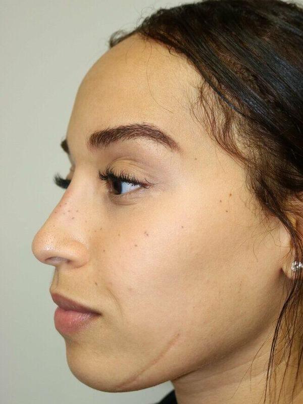 Non-Surgical Nose Job Before & After Image