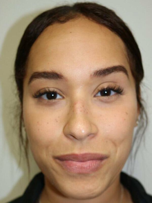 Non-Surgical Nose Job Before & After Image