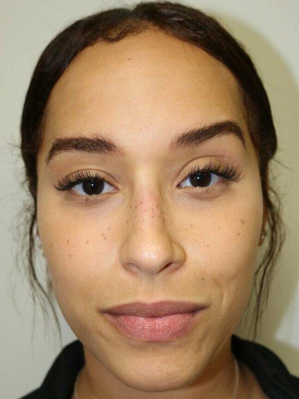 Non-Surgical Nose Job Before & After Image