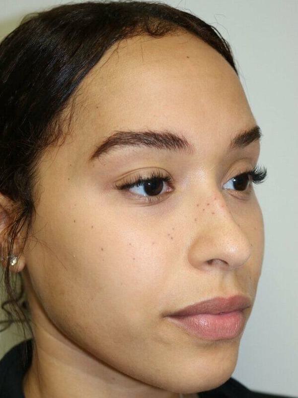 Non-Surgical Nose Job Before & After Image