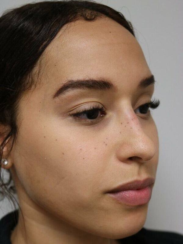 Non-Surgical Nose Job Before & After Image