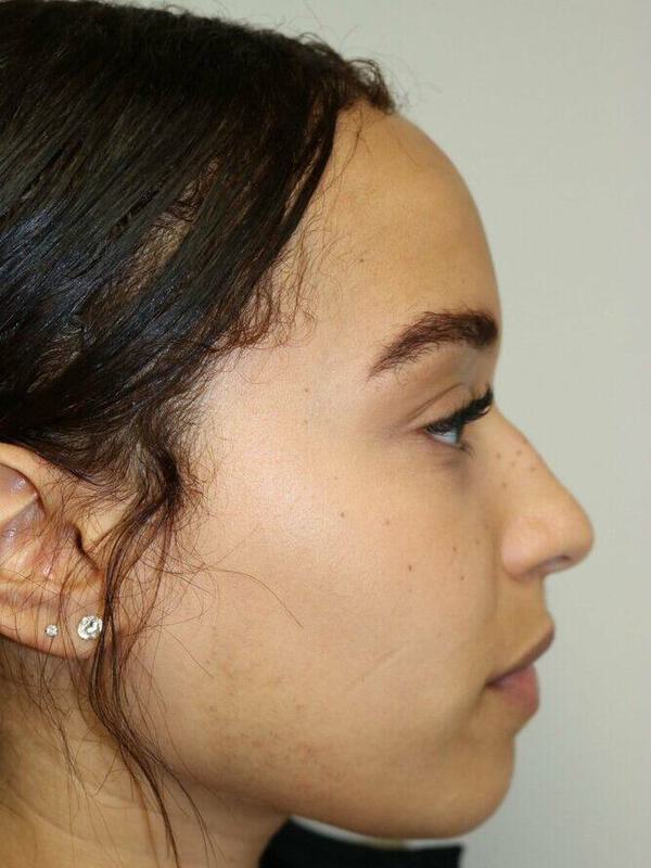 Non-Surgical Nose Job Before & After Image