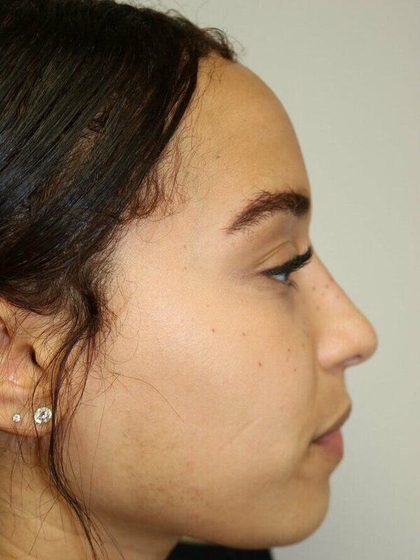 Non-Surgical Nose Job Before & After Image