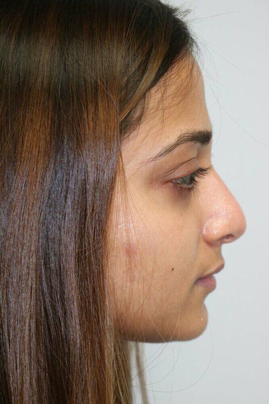 Non-Surgical Nose Job Before & After Image