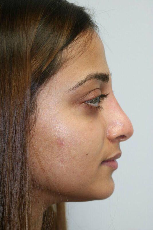 Non-Surgical Nose Job Before & After Image