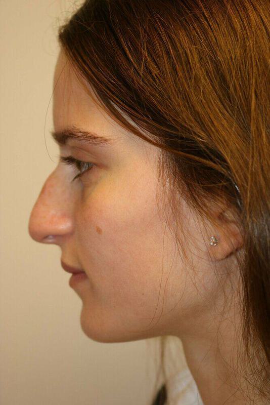 Non-Surgical Nose Job Before & After Image