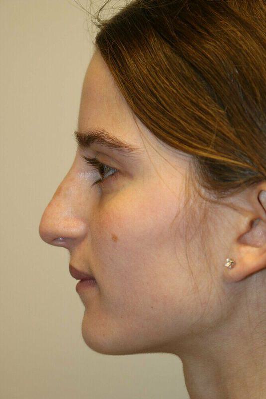 Non-Surgical Nose Job Before & After Image