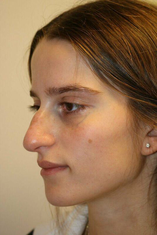 Non-Surgical Nose Job Before & After Image