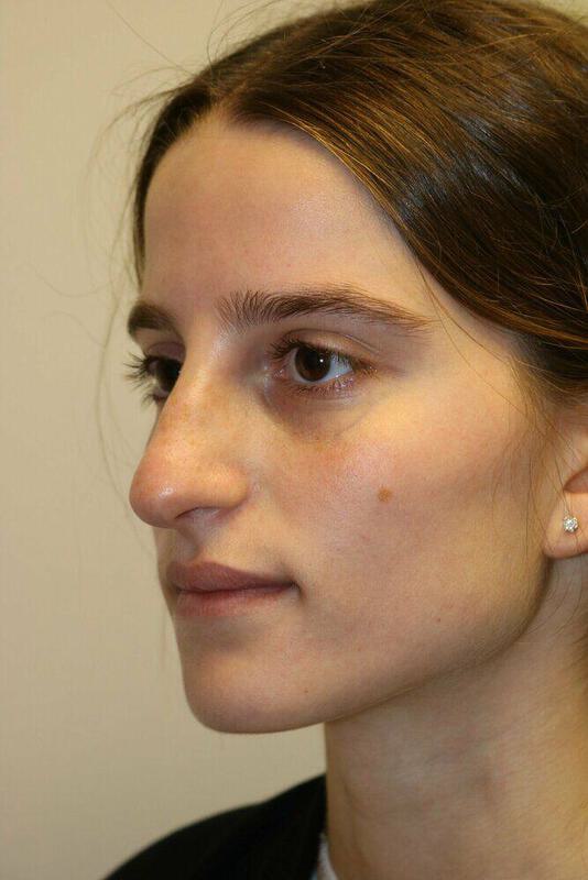 Non-Surgical Nose Job Before & After Image