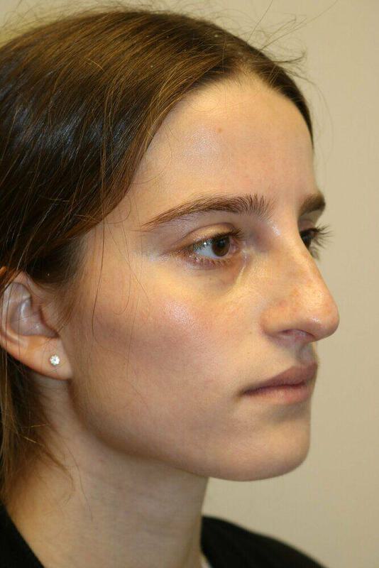 Non-Surgical Nose Job Before & After Image